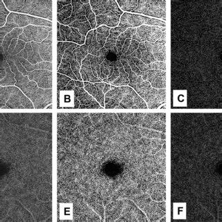 Images Of The Right Eye From Swept Source Optical Coherence Tomography