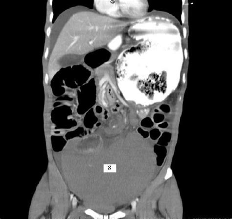 The Enlarged Spleen Located In The Pelvis With Hemoperitoneum Sspleen