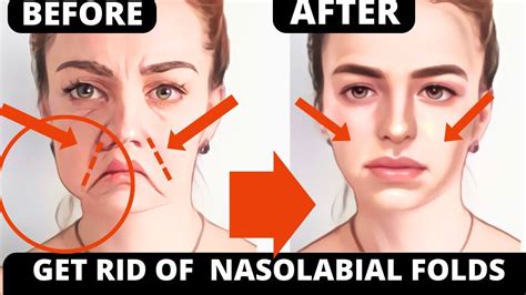 25 Min Facial Exercises For Nasolabial Folds Laugh Lines Lift