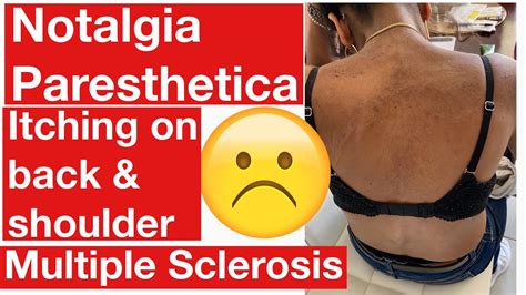 Notalgia Paresthetica Itching Back Shoulder With Multiple Sclerosis