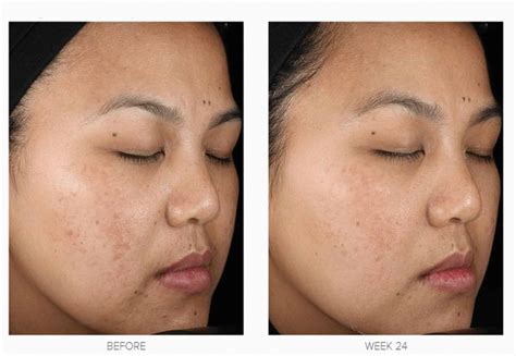 Melasma Pigmentation Treatment Diamond Aesthetics