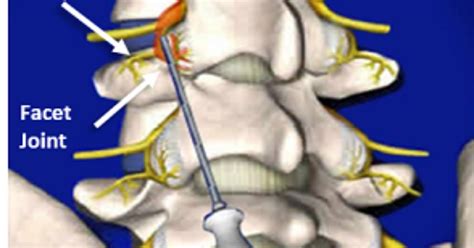 Sacroiliac Joint Radiofrequency Ablation