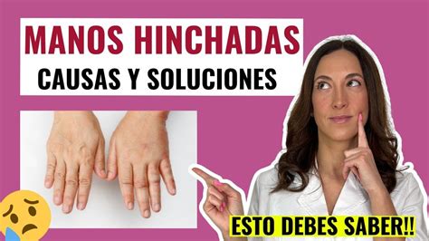 Por Qu Se Hinchan Las Manos Remedios Efectivos Para