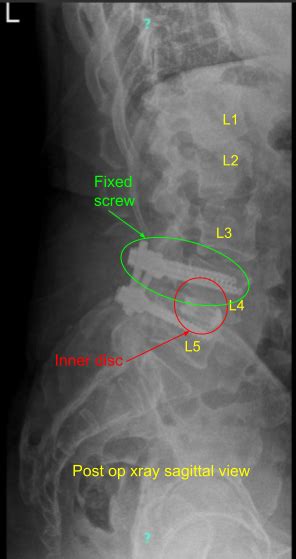 Revision Decompression Of L L Complete Orthopedics Ny