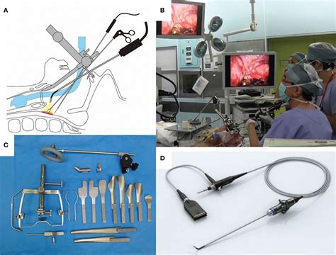 Frontiers Current Status Of Transoral Surgery For Patients With Early Stage Pharyngeal And