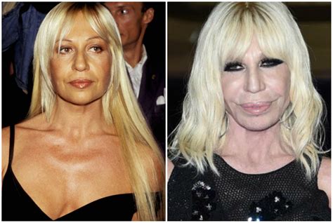 Le Star Prima E Dopo La Chirurgia La Trasformazione Di Donatella