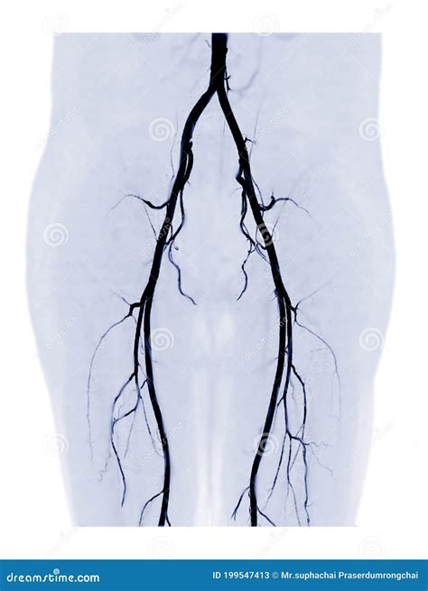 Cta Femoral Artery Run Off 3d Mip Image Stock Illustration