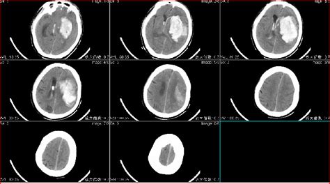 一例大量脑出血的内镜治疗 颅脑创伤 神经重症病例周刊（137期） 脑医汇 神外资讯 神介资讯