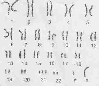 Klinefelter Syndrome Chromosomes