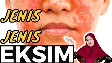 Penyakit Kulit Eksim Basah Eksim Kering Eczema Youtube