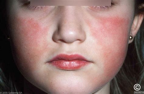 Erythema Infectiosum Syn Fifth Disease Slapped Cheek Syndrome