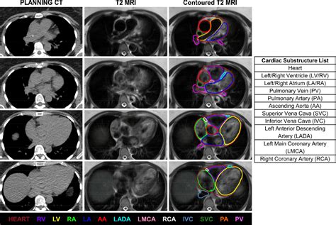 Figure From Cardiac Substructure Segmentation And Dosimetry Using A