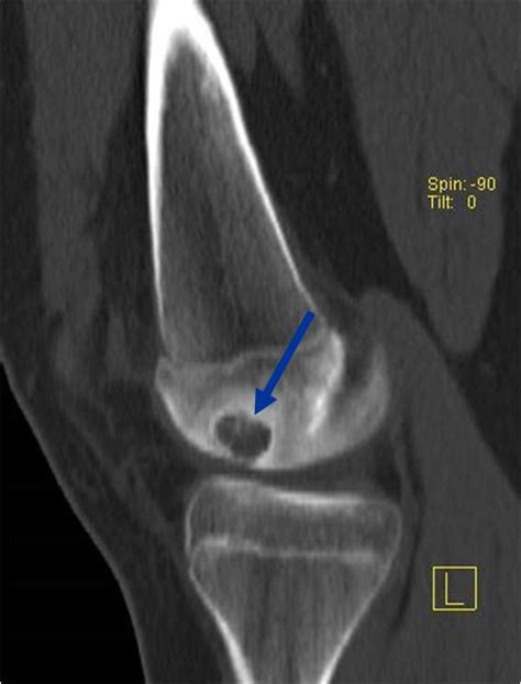 Chondroblastoma Bone Tumors Tumors Of The Bone