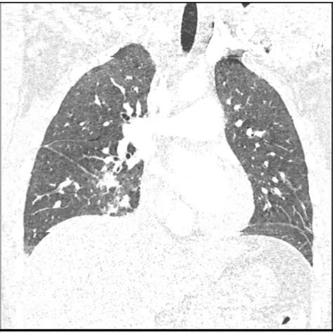 A Grade 1 Liver Laceration A Highlighted In The Solid Black Circle