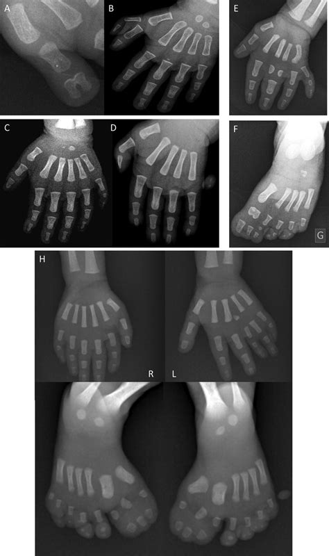 Different types of polydactyly. (A, B) Preaxial polydactylies. (C) Type ...