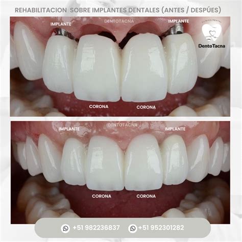 Implantes Dentales en Tacna Tipos y Precios 2023 Implatólogos