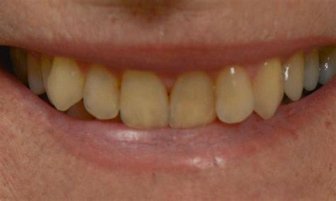 Before And After Tooth Crowns Brisbane Edward St Dental