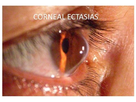 Corneal Ectasia