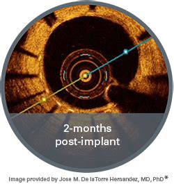 SYNERGY Coronary Stent System - Boston Scientific