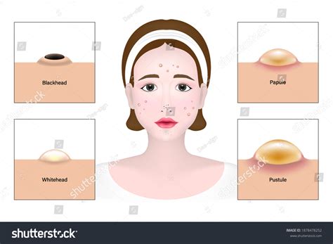 Women Types Acne Skin Problems Vector Stock Vector Royalty Free