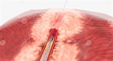 The Catheter Is Used To Deliver The Stent Stock Illustration