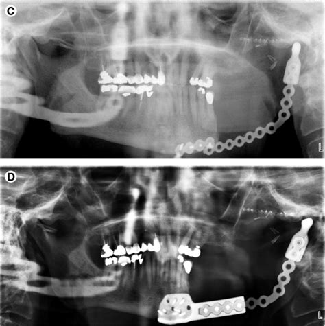 Customized Repair Of Fractured Mandibular Reconstruction Plates