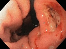 Stomach Ulcer Ultrasound