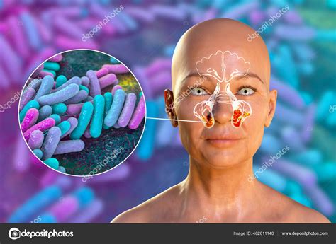 Sinusitis Inflamación Las Cavidades Paranasales Ilustración Que Muestra