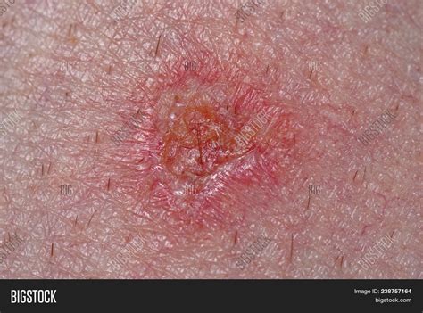 2nd Degree Sunburn Leg