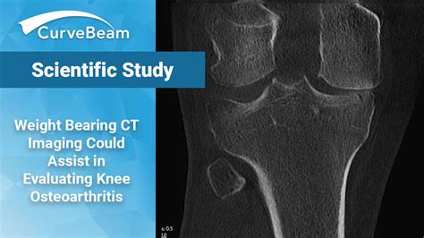 Weight Bearing Ct Imaging Could Assist In Evaluating Knee