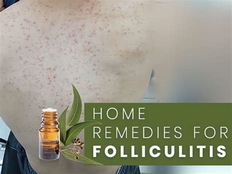 Folliculitis: Simple And Effective Home Remedies - Boldsky.com