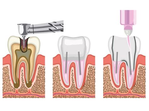 Qué es una endodoncia Clínica Dental Los Valles