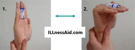 Boutonniere Deformity: Cause, Exercises, and More - ILLnessAid