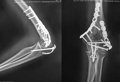 Distal Humerus Anatomy