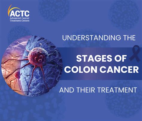 Understanding The Stages Of Colon Cancer