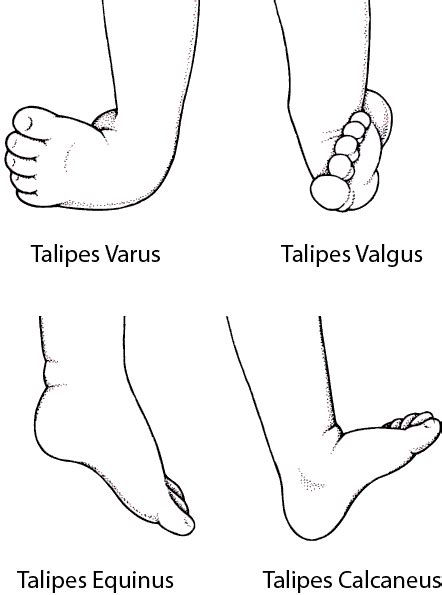 Varus And Valgus Deformity Of The Foot Stock Vector Colourbox ...