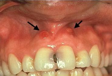 Canker Sore In Mouth Tongue Lips And Gums Pictures Causes And