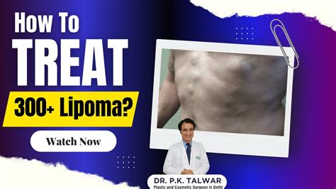 Treatment Of 300 Plus Lipoma Multiple Lipoma Removal Lipoma