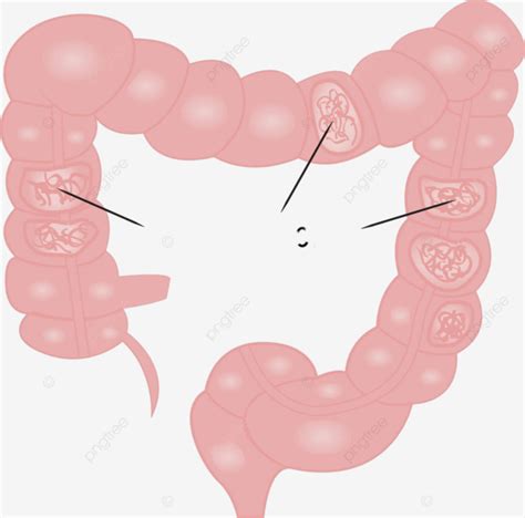 Ulcerative Colitis Intestine Disease Problem Gut Intestinal Vector