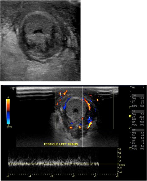 Ultrasound With Doppler Left Testicle Demonstrating Marked Tunica