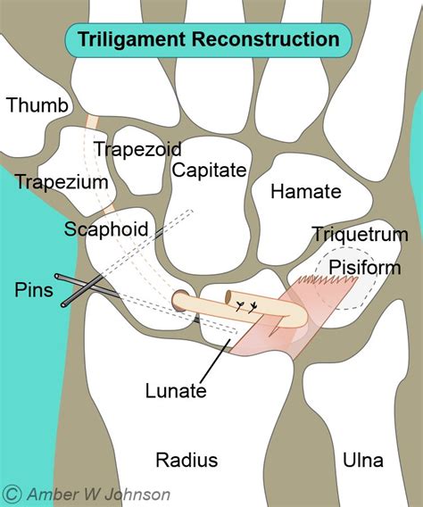 Scapholunate Ligament Injury Alaska Hand Elbow Shoulderalaska