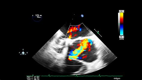 Use of Ultrasound in Cardiac Arrest | EM Ultrasound Section