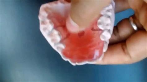 Watch The Bite Plane For Deep Bite Orthodontics Youtube