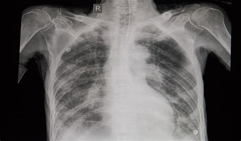 Edema Pulmonar Radiografia Image To U