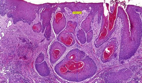 Histopathological Slide Of An Oral Squamous Cell Carcinoma Showing