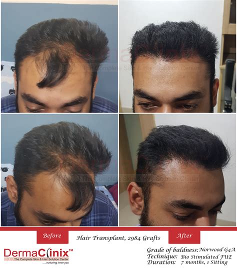 Hair Transplant Surgery Prp Results Before And After Photos India