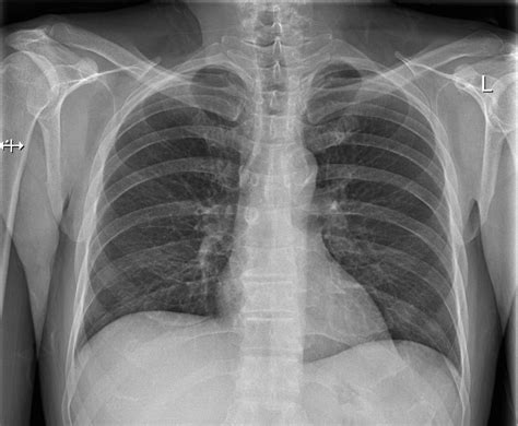 Practice Chest X Ray Interpretation