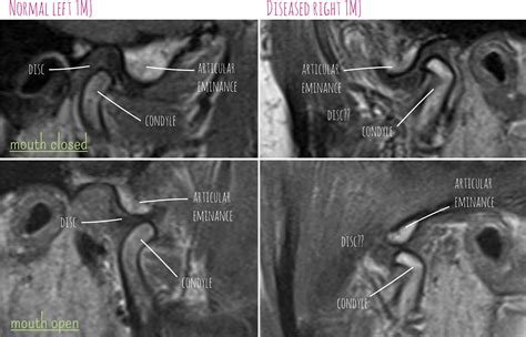 Tmj Diaries Tmj Mri Scans