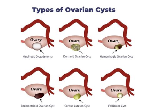 Ovarian Cysts - Causes, Types, Symptoms and Treatments