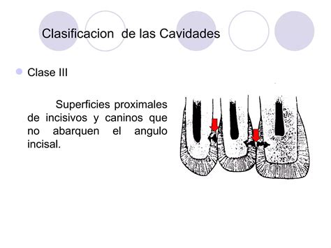 Tema 05 Nomenclatura Y Clasificacion De Las Cavidades PPT